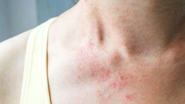 What is Atopic Dermatitis?